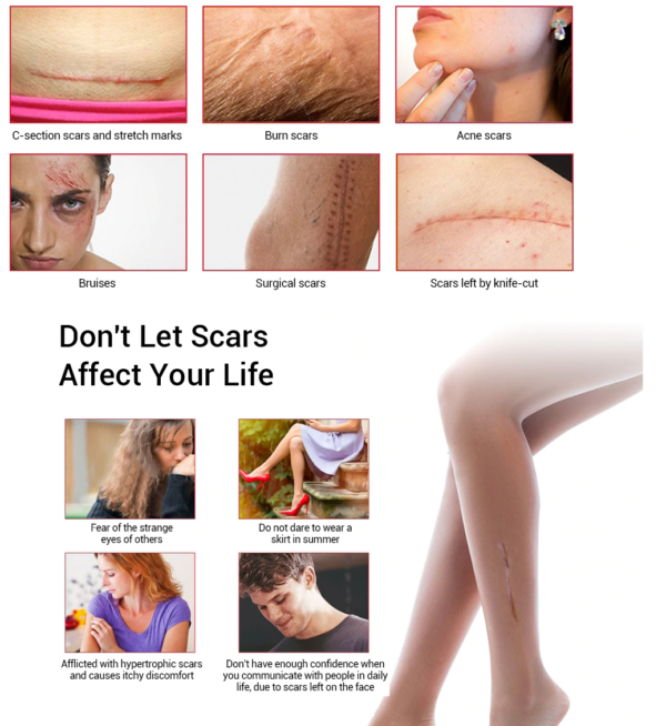 scar gel for scars and acne treatment