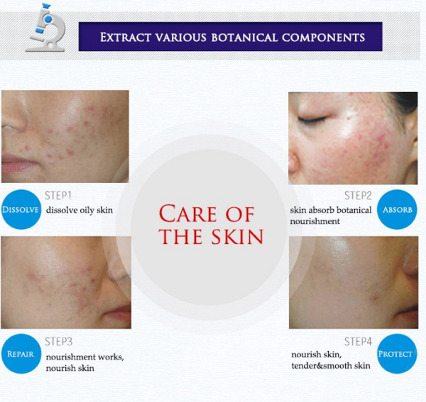 bioaqua acne cream