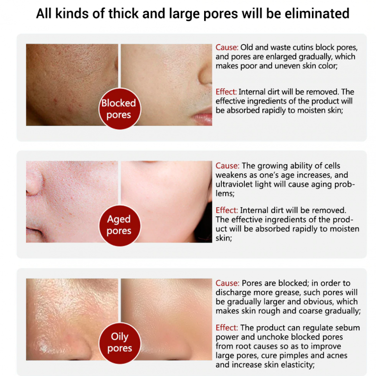 LANBENA Open Pores and blackheads Treatment Essence Homely.pk