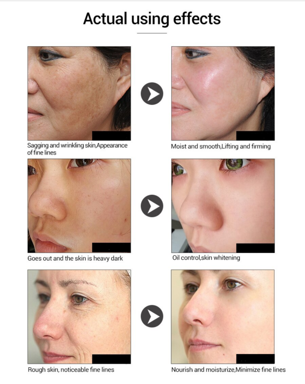 results of lanbena hyaluronic acid serum