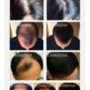 Lanbena hair regrowth spray effects