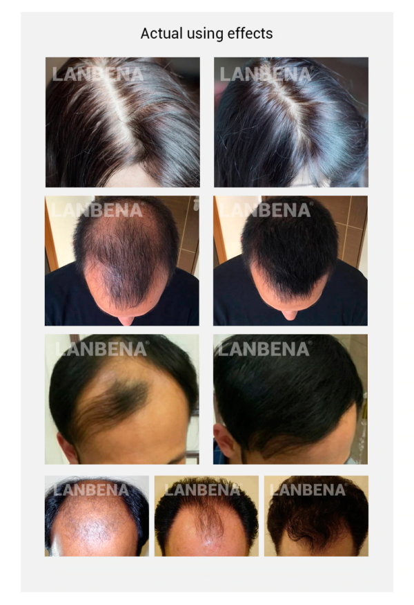 Lanbena hair regrowth spray effects