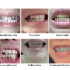 common teeth issues